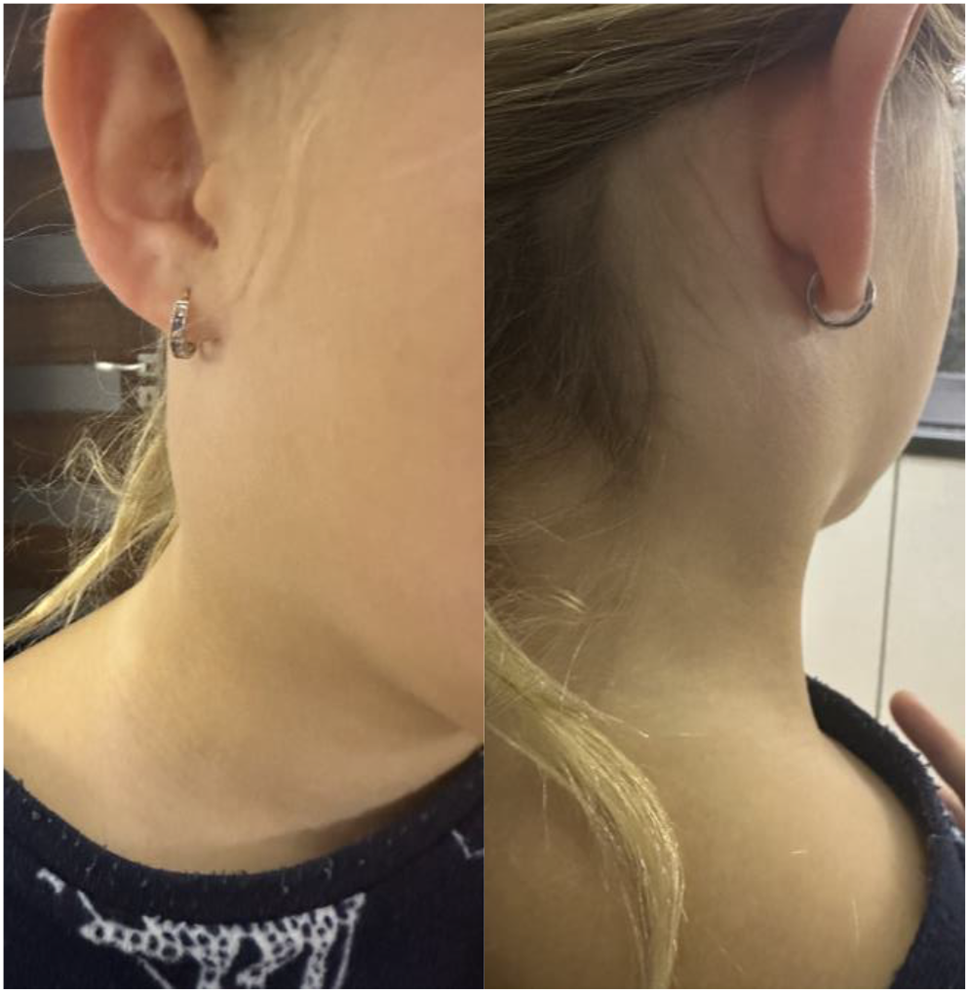 Absceso aséptico como primera manifestación de la enfermedad de Crohn: reporte de un caso